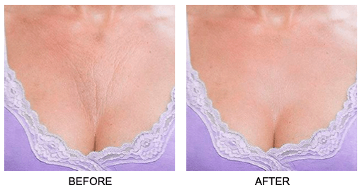 Chest Wrinkle Patch | Reusable Skin Plumping Chest Mask